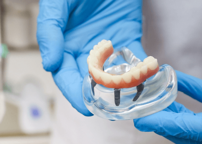 the cost of dental implants mobi